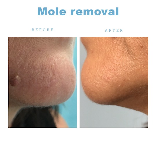 Mole removal in Birmingham - Dr Sajjad Rajpar, Dermatologist