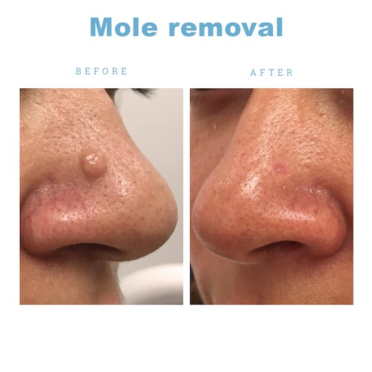 Forever Young Clinic Mole Removal