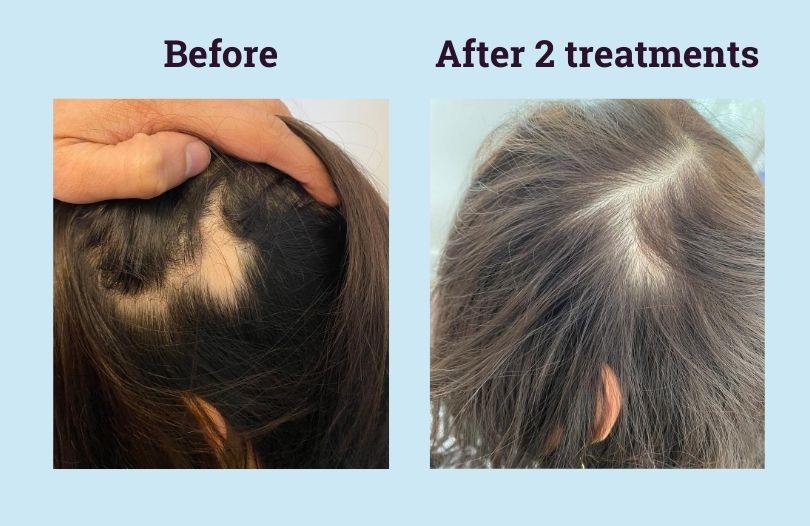 Hair Rejuvenation in Dayton Ohio  Hair Rejuvenation Injections in  Kettering  Dayton  Ohio Skin Center