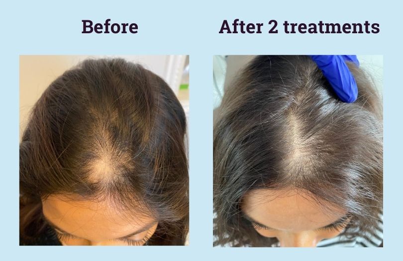 Hair Growth Plasma Injections Liverpool  Aesthetically You