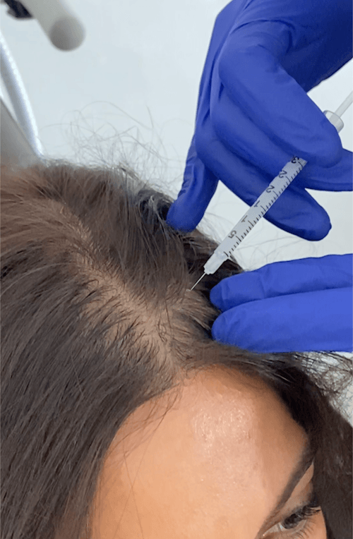 No More Hair Loss with Homeopathic Treatment  Dr Batras