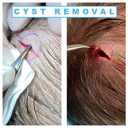 ingrown hair cyst neck