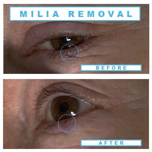 Retinol Treatment For Milia At Sergio Hasting Blog