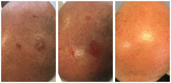 Seborrhoeic keratosis removal - Midland Skin