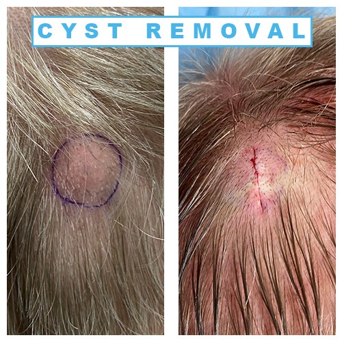 Epidermoid Cyst Scalp