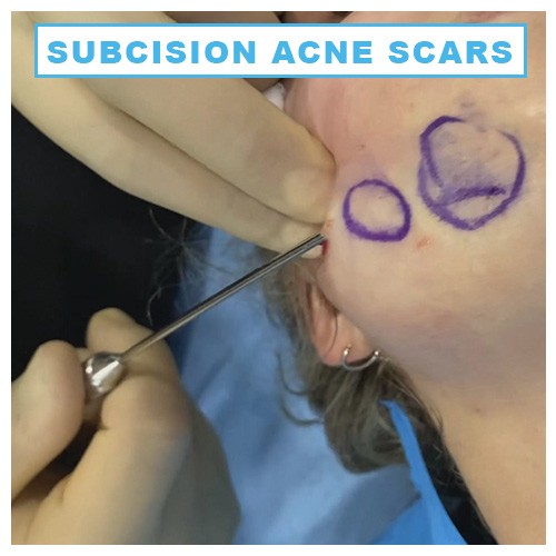 Subcision for acne scars - Midland Skin