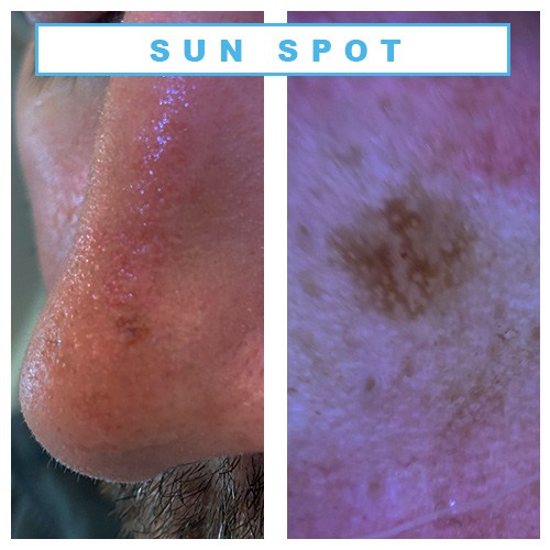 Body Bumps That Look Like Acne — But Aren't – SLMD Skincare by Sandra Lee,  M.D. - Dr. Pimple Popper
