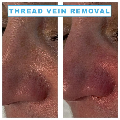 Thread Vein Treatment