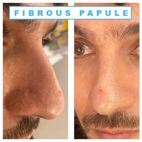 Fibrous papule | Fibrous papule of the nose | Fibrous papule treatment