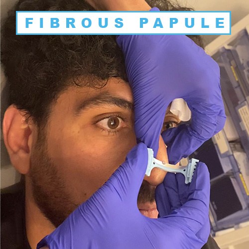 Fibrous Papule Fibrous Papule Of The Nose Fibrous Papule Treatment