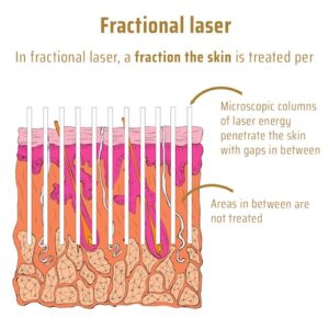 Choosing Between Fully Ablative and Fractional Laser Resurfacing