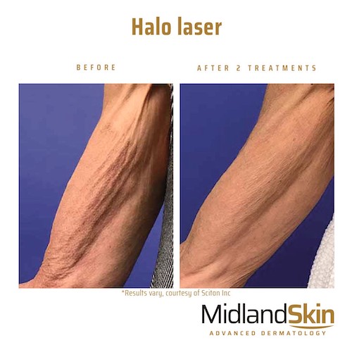 Halo laser Midland Skin