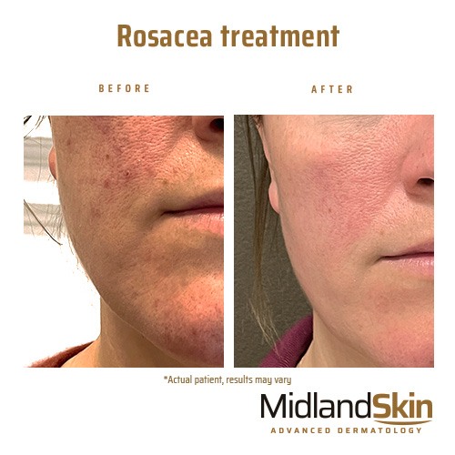 klassisk Vandt lys s Rosacea, Redness and Flushing - Birmingham - Midland Skin