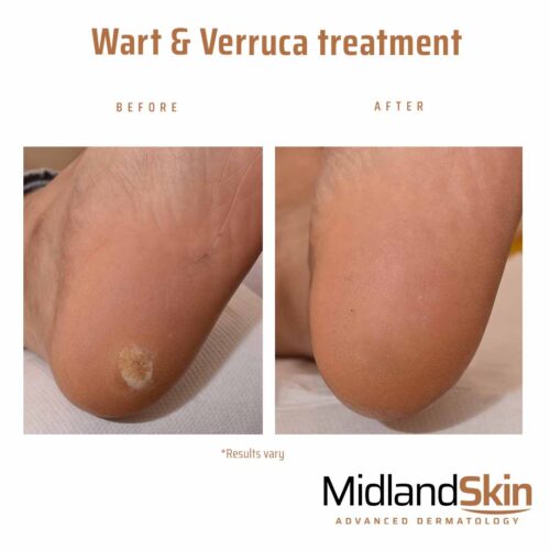 Scars After Wart Removal at Gladys Starr blog