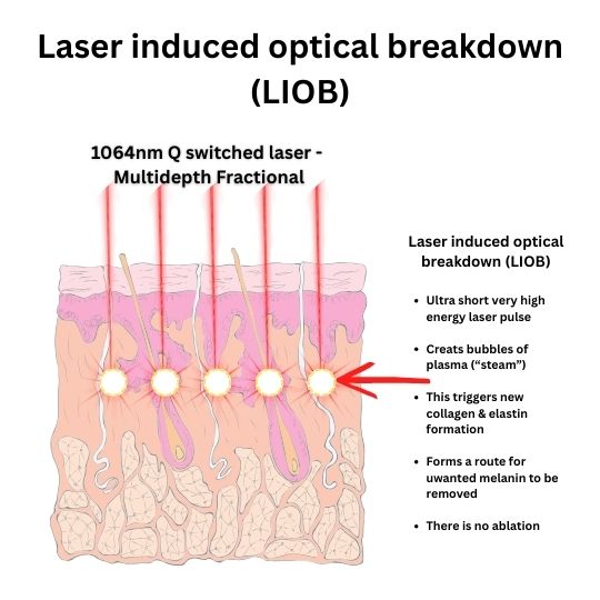 How Hollywood Spectra MDF laser resurfacing works