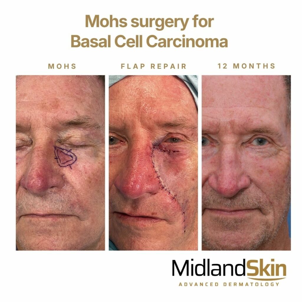 Before and After Mohs Surgery at Midland Skin